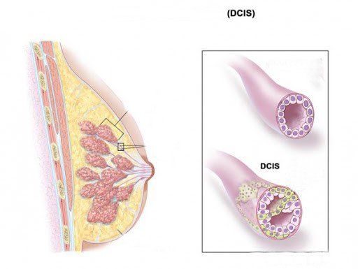 Ung thư biểu mô ống tại chỗ (DCIS)