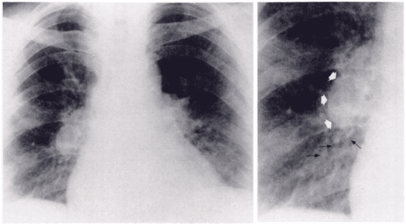 Dấu hiệu thuyên tắc phổi trên X quang ngực