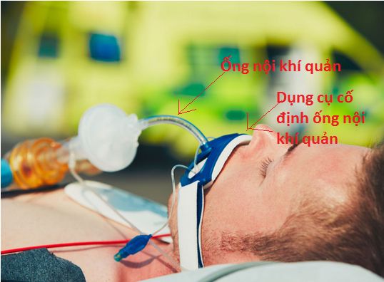 Người bệnh đang được thở máy qua ống nội khí quản (Nguồn hình: https://www.healthline.com)