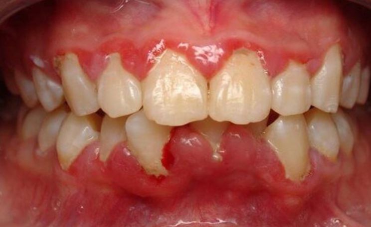 Cao răng gây viêm lợi: lợi sưng, đỏ, phù nề.