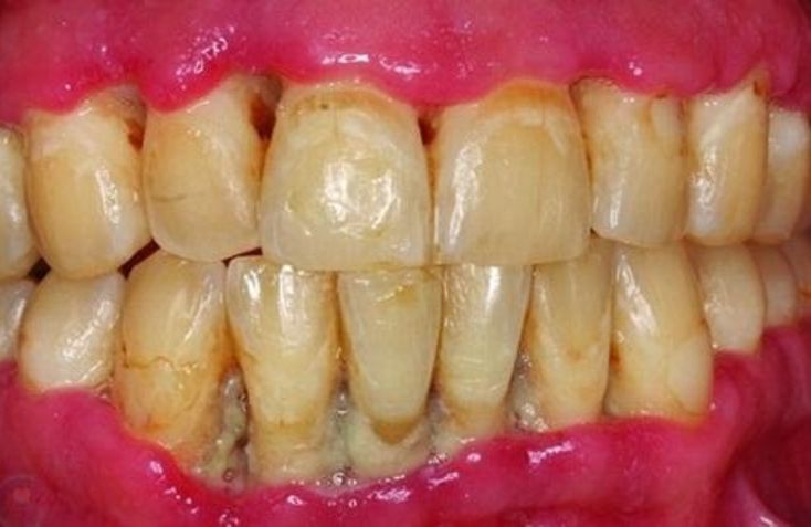 Cao răng gây tụt lợi, viêm quanh răng.