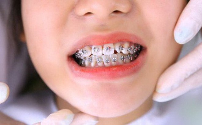 Có nên cho trẻ 8 tuổi niềng răng không?