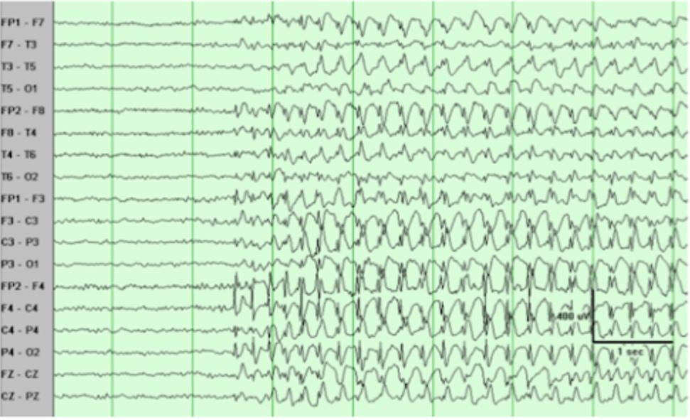 Điện não đồ (EEG) động kinh xuất hiện các hoạt động kịch phát gai nhọn sóng