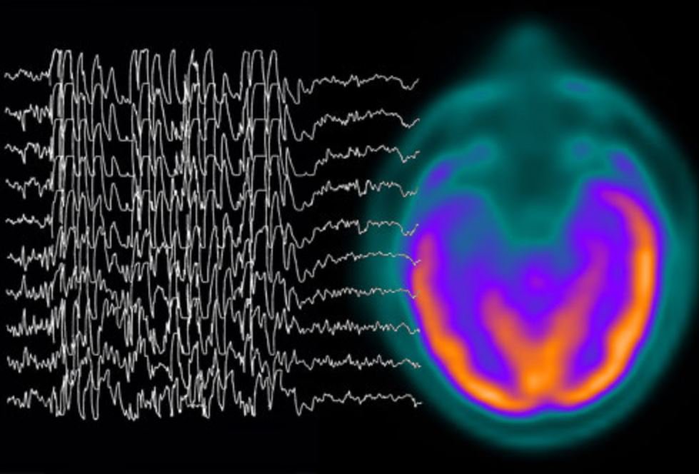 Điện não đồ (EEG)