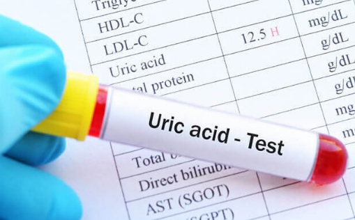 Xét nghiệm sinh hóa máu acid uric