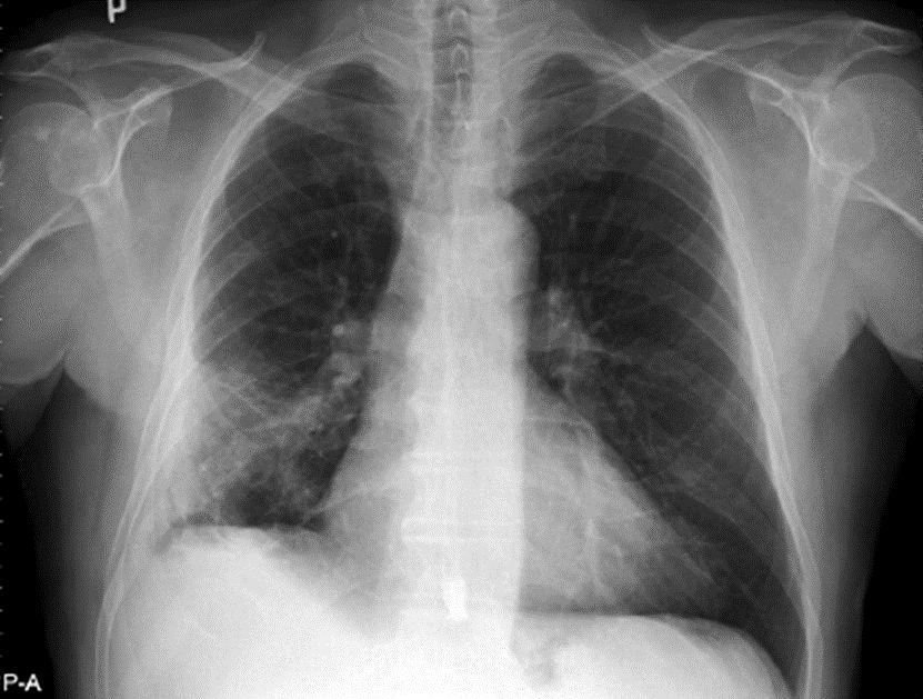 hình ảnh X-quang viêm phổi do Coronavirus 3.1 Đặc điểm chung