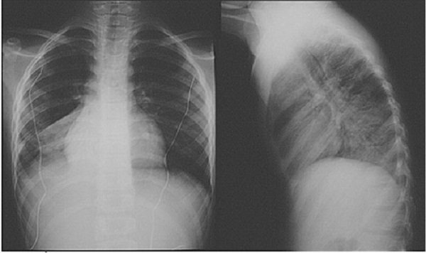 Chụp X quang phổi