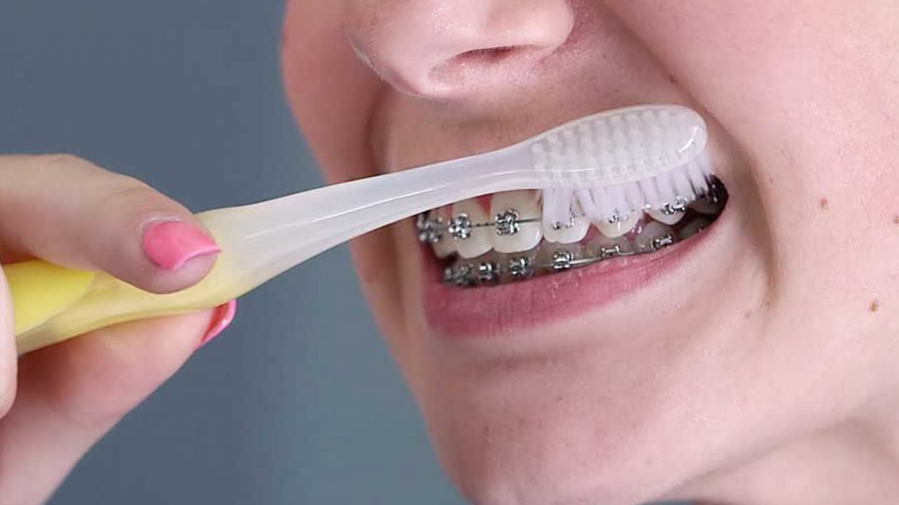 Vệ sinh răng miệng cũng ảnh hưởng đến thời gian niềng răng