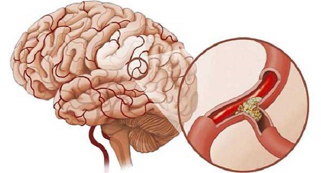 Nhồi máu não sau khi phẫu thuật sẽ giúp cải thiện khả năng ngôn ngữ của bệnh nhân