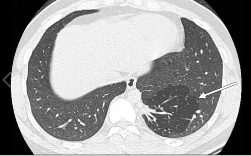 MRI phổi