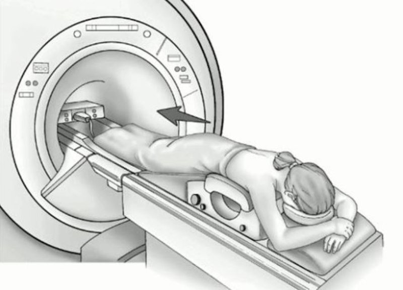 MRI vú
