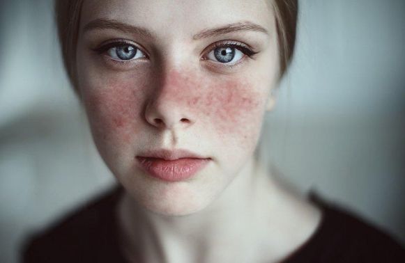 Lupus ban đỏ hệ thống