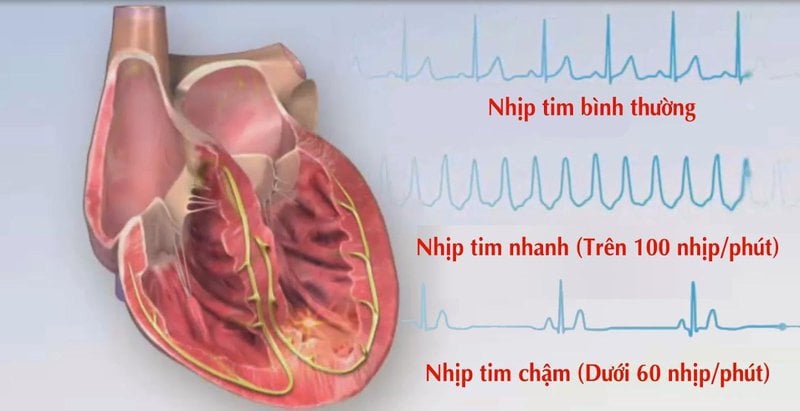 Bệnh nhân mắc rối loạn nhịp tim cần được xét nghiệm chuyên sâu trước khi phẫu thuật