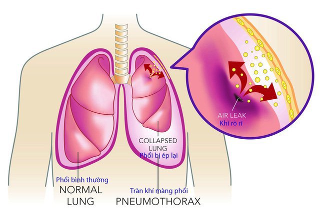 Bệnh nhân bị tràn dịch màng phổi được chỉ định rửa màng phổi