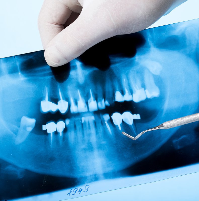 Chụp X-quang răng có những loại nào?