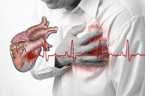 Đau thắt ngực là triệu chứng của bệnh trái tim tan vỡ