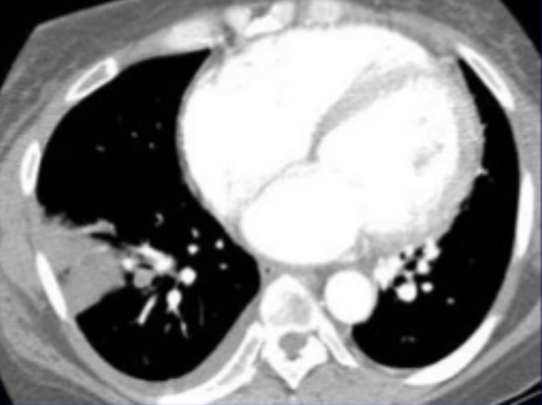 Nhồi máu phổi trên phim CT: Hình mờ tam giác, đáy nằm trên màng phổi và đỉnh hướng về rốn phổi