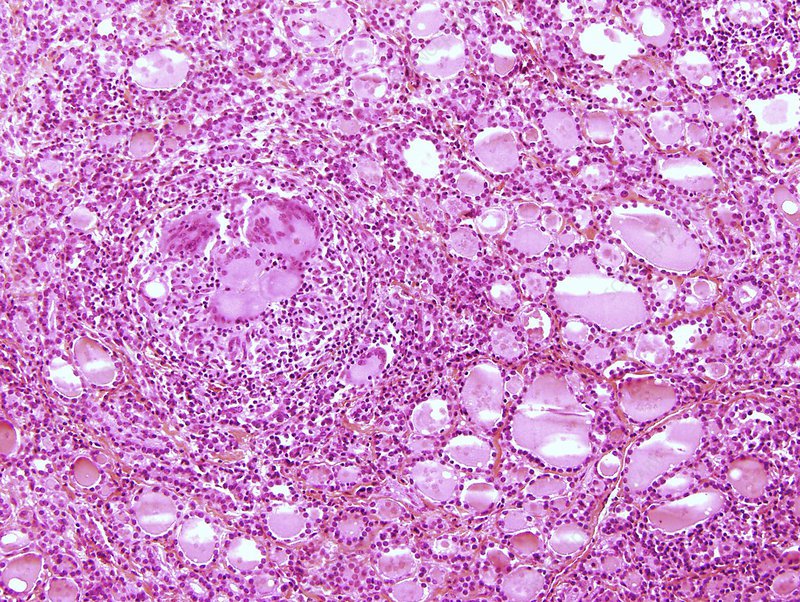 Hình ảnh tế bào viêm tuyến giáp dạng hạt (bán cấp)