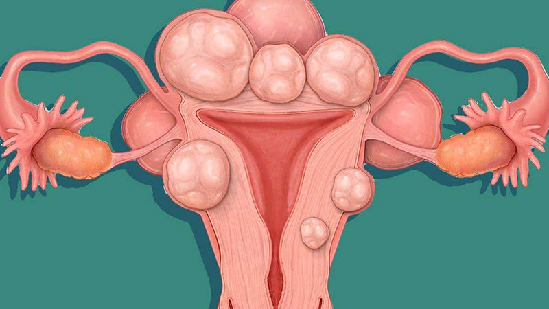 U xơ tử cung thường là những khối u lành tính