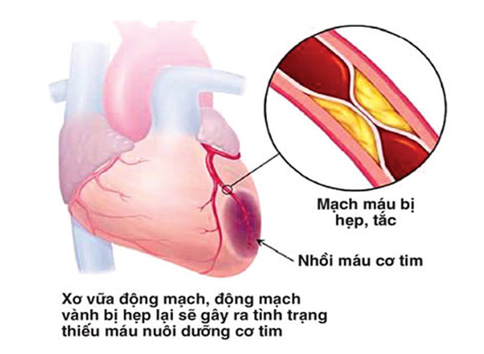 Những người mắc chứng xơ vữa động mạch có nguy cơ cao mắc nhồi máu cơ tim