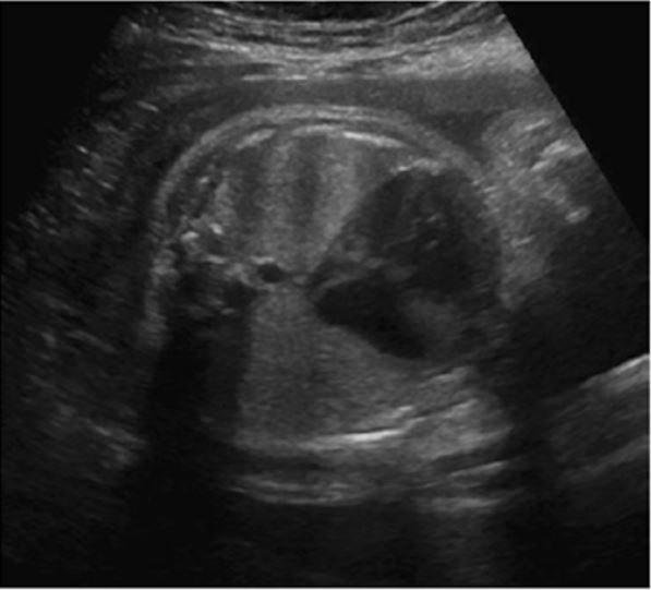 Hình ảnh thiểu sản tim trái trong siêu âm thai