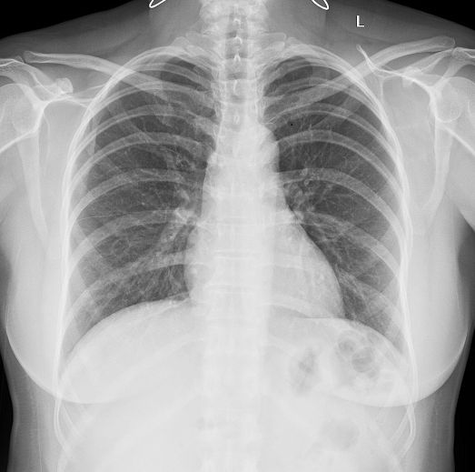 X-quang phổi bình thường