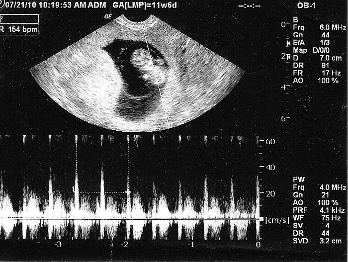 Hình ảnh tim thai bình thường khi siêu âm
