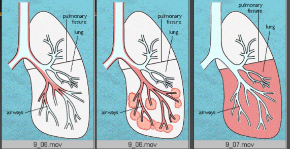 Bệnh phổi kẽ