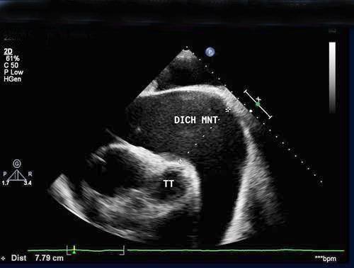 Hình ảnh tràn dịch màng ngoài tim trên siêu âm