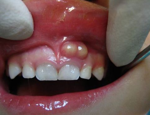 Abscess ở vùng cuống răng.