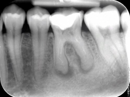 Răng bị nhiễm trùng cuống
