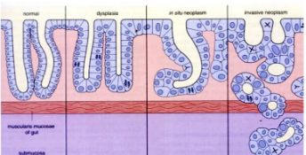 Dị sản (dysplasia)