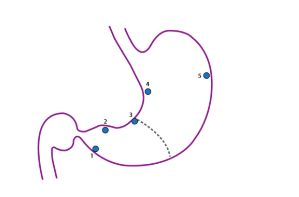 Hình 12. Gastric mapping. Sinh thiết 5 chỗ.