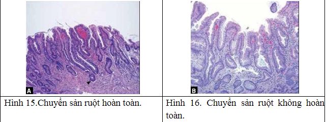 Chuyển ruột