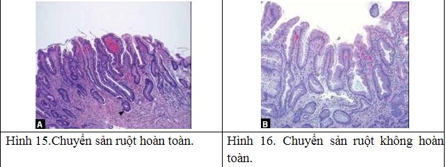 Chuyển ruột