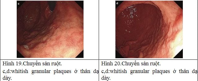 Chuyển sản dạ