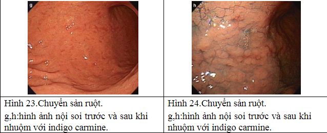 Chuyển sản dạ