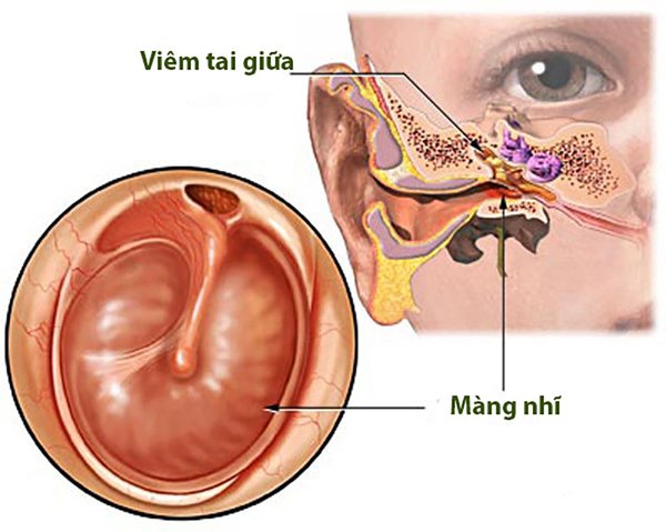 Viêm tai giữa có gây thủng màng nhĩ không?