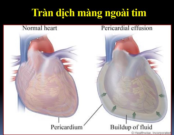 Tràn dịch màng ngoài tim