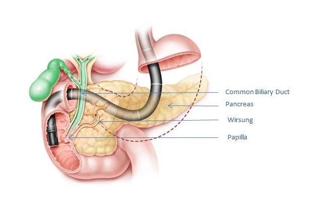 Hình 1. Hình ảnh minh họa kỹ thuật ERCP:  Máy nội soi (màu đen); Nhú tá tràng (Papilla); Ống tụy chính (Wirsung); Ống mật chủ (Common Biliary Duct); Tụy (Pancreas).