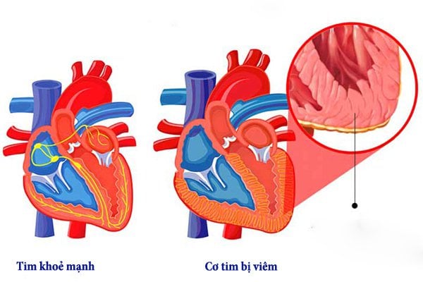 Viêm cơ tim là biến chứng nguy hiểm của tay chân miệng