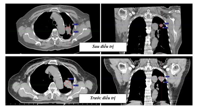 08 Thể tích khối u phổi của bệnh nhân đã giảm đáng kể sau xạ trị SBRT