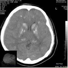 chụp cắt lớp vi tính sọ não