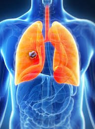 Ung thư phổi không tế bào nhỏ