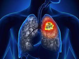 ung thư phổi không tế bào nhỏ giai đoạn di căn