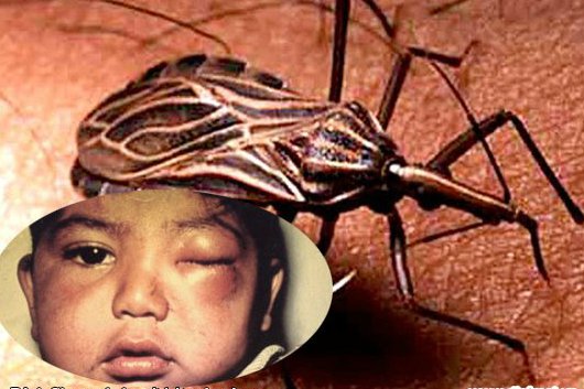 Bệnh Chagas