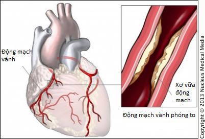 Bóc tách động mạch vành