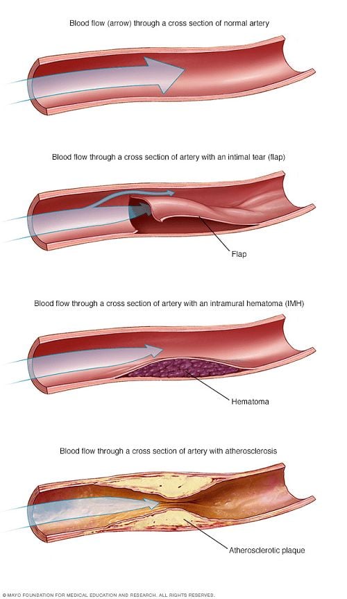 Bóc tách động mạch vành
