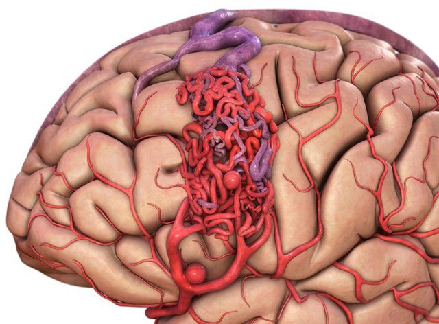 dị dạng mạch máu não (AVM)
