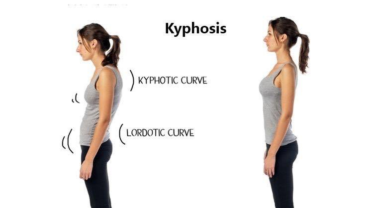bệnh kyphosis